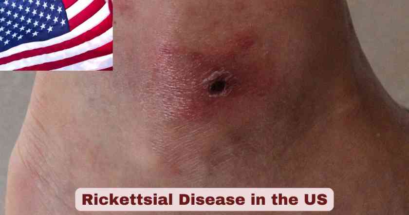 Rickettsial Disease in the US
