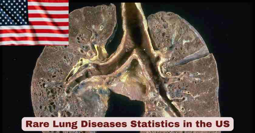 Rare Lung Diseases in US