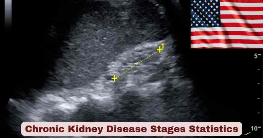 Chronic Kidney Disease Stages Statistics