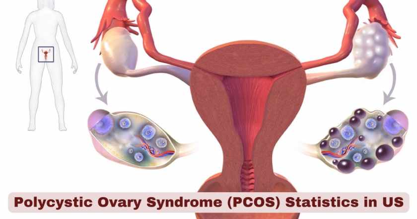 Polycystic ovary syndrome PCOS in US