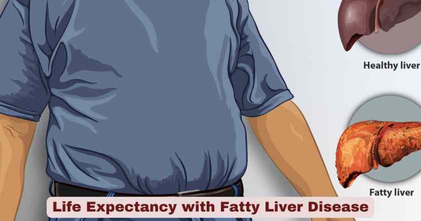 Life Expectancy with Fatty Liver Disease