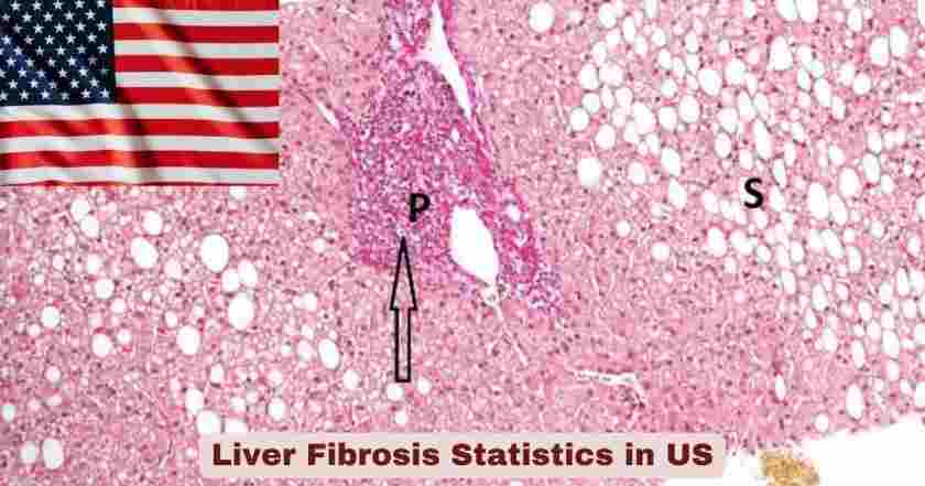 Liver Fibrosis Statistics in US