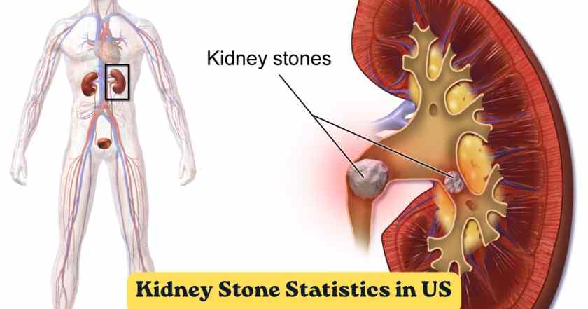 Kidney Stone Statistics in US